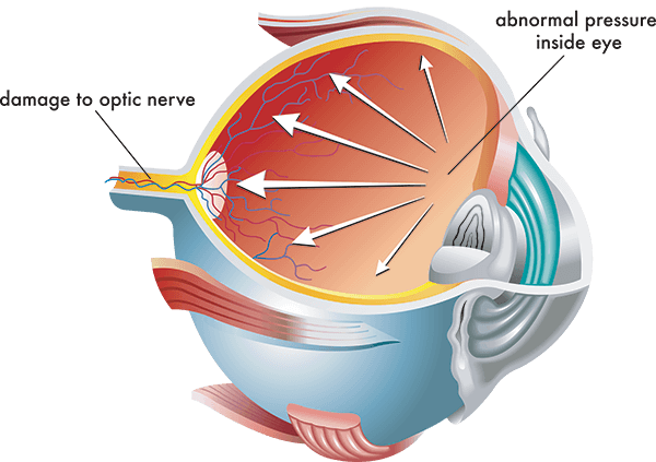 Chart Illustrating How Glaucoma Affects an Eye